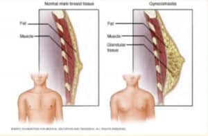 Illustration of diagnosing gynecomastia in adolescents