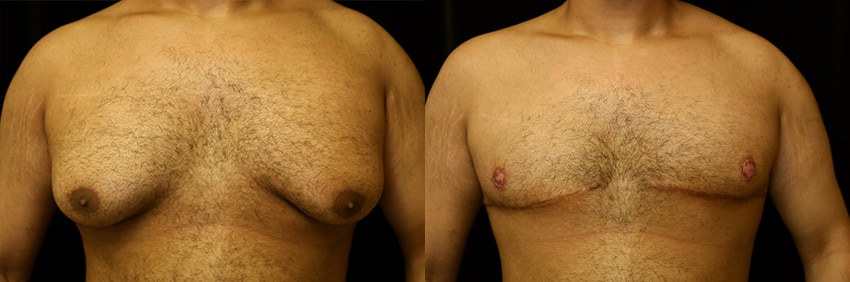 Gynecomastia before and after photo 