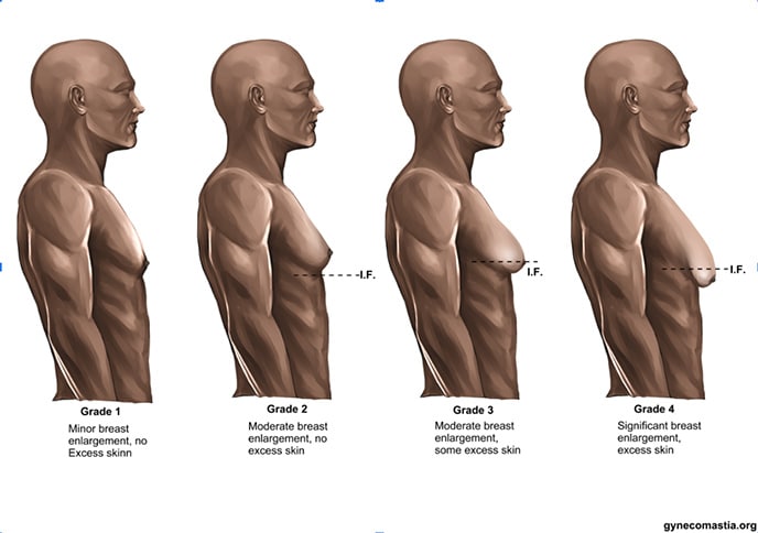 Gynecomastia grade chart