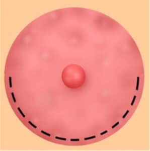 An illustration of the nipple-areola complex (NAC) and the peri-areola (Webster) incision.