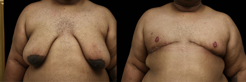 A male patient after significant semaglutide weight loss before gynecomastia surgery.