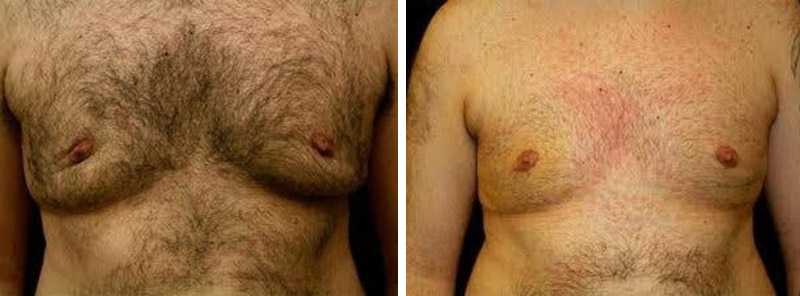 Treatment of same patient with bilateral fat flaps.