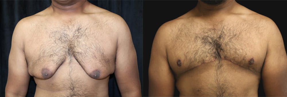 Before and After Gynecomastia Surgery